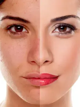Manage hyperpigmentation