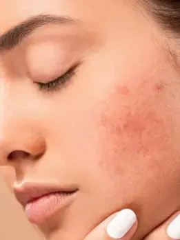 Prevent future breakouts