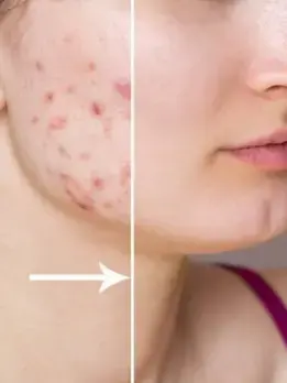 Reduce acne scars